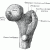 Femur_head