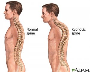 IMAGE Illustration of a man with a normal spine and with a kyphotic (rounded or hunched) spine. IMAGE